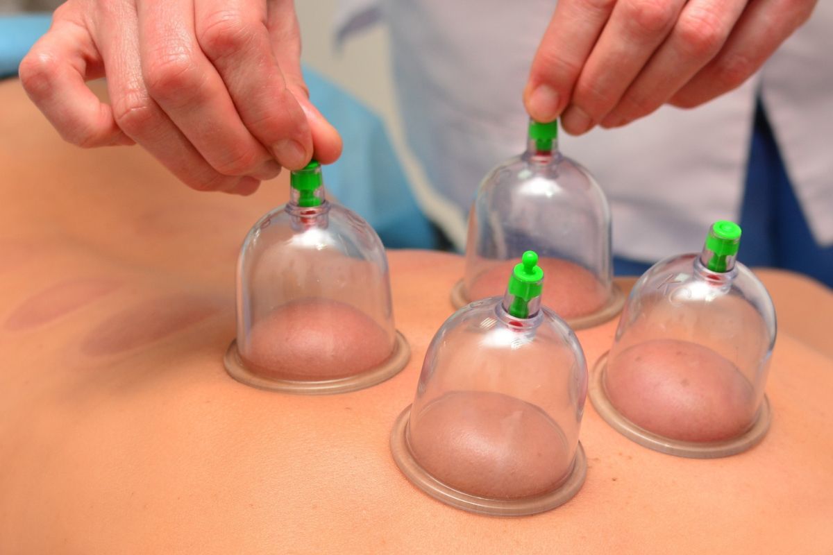 Cupping masaža leđa sa staklenim čašicama koje stvaraju podtlak i potiču cirkulaciju