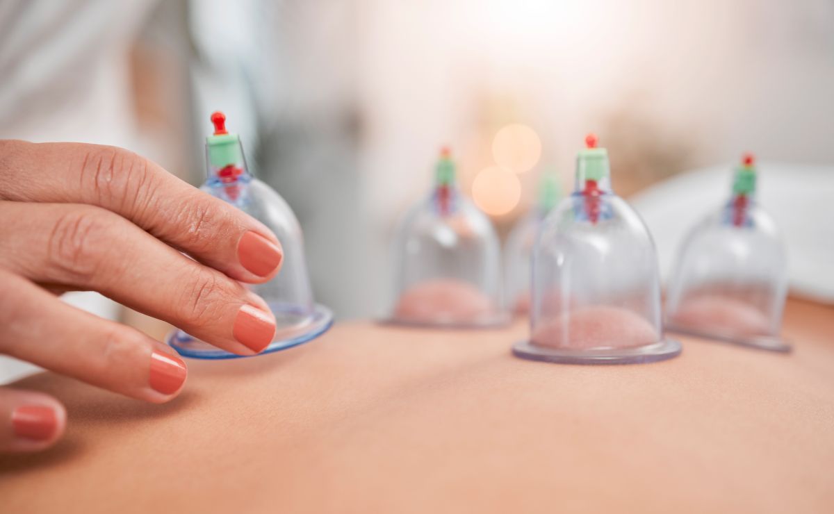 Masaža s vakuumskim čašicama – cupping tretman na leđima s više postavljenih čašica