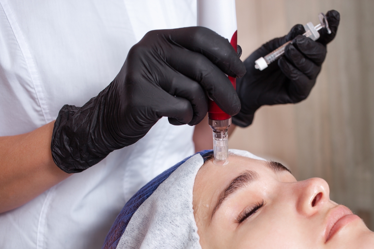 Microneedling tretman lica