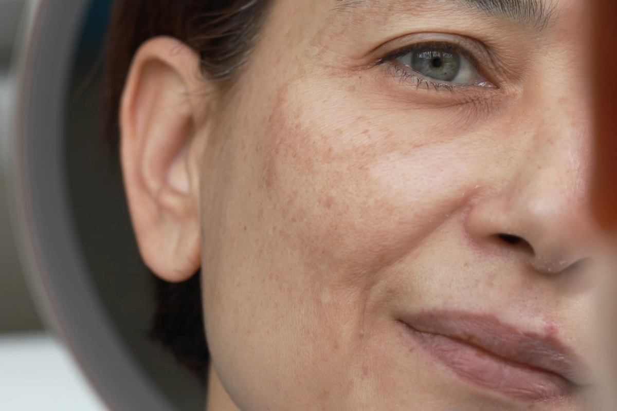 starija žena se gleda u ogledalo sa fokusom hiperpigmentacije kože