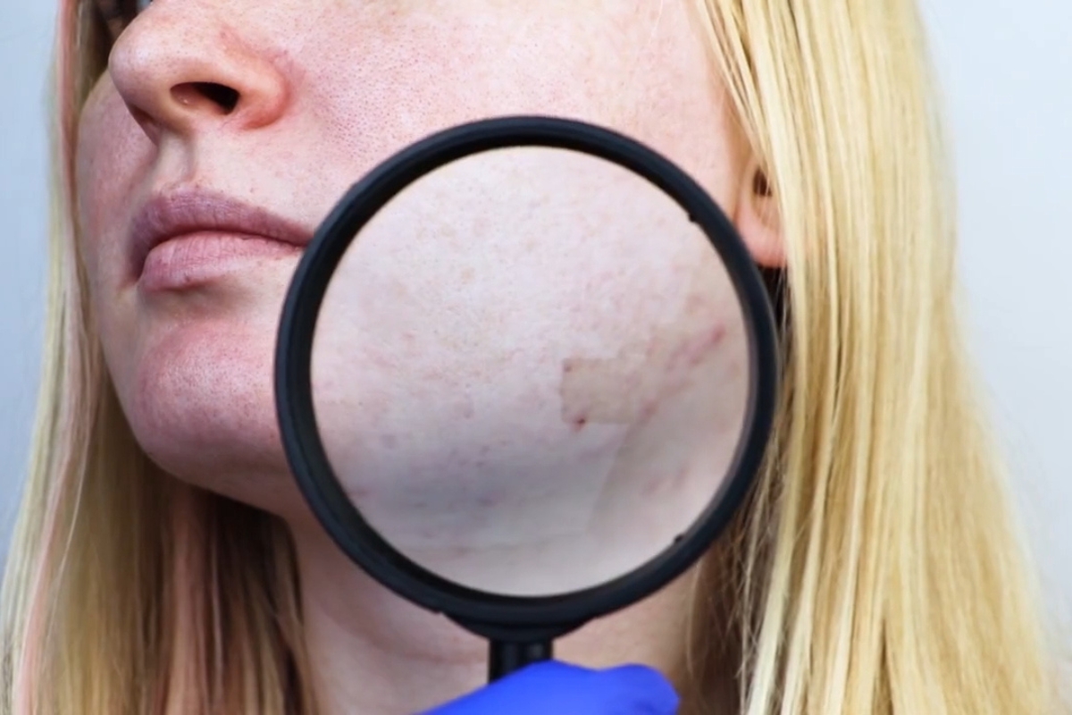 djevojka kod dermatologa na pregledu akni
