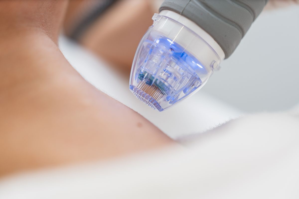 Krupni prikaz microneedling uređaja s mikroiglicama tijekom tretmana kože